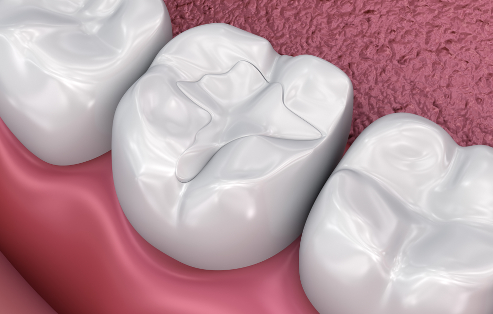 Dental Fillings – Charlotte, NC - Advanced Dentistry of Blakeney