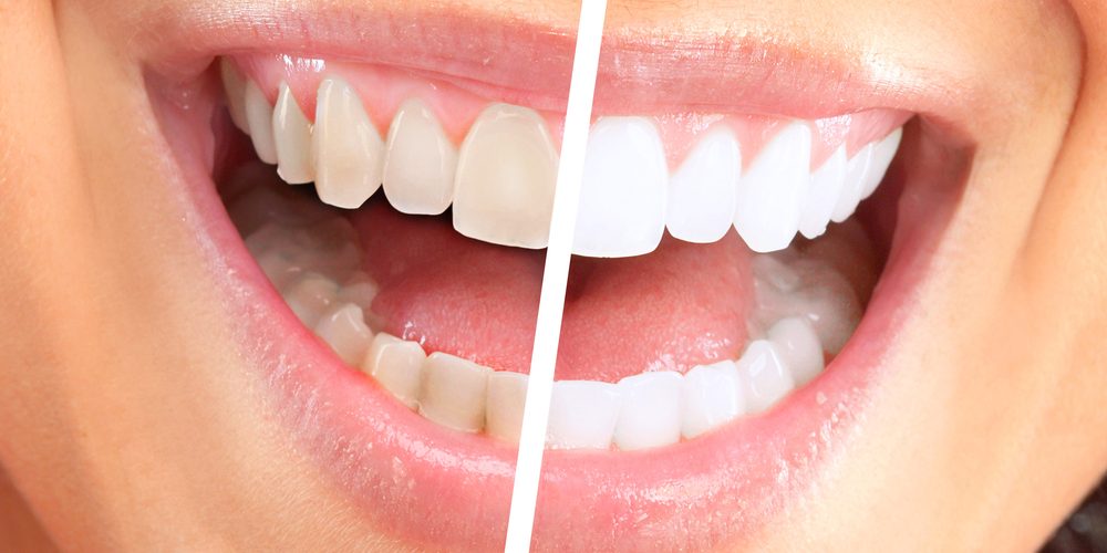 teeth whitening near me