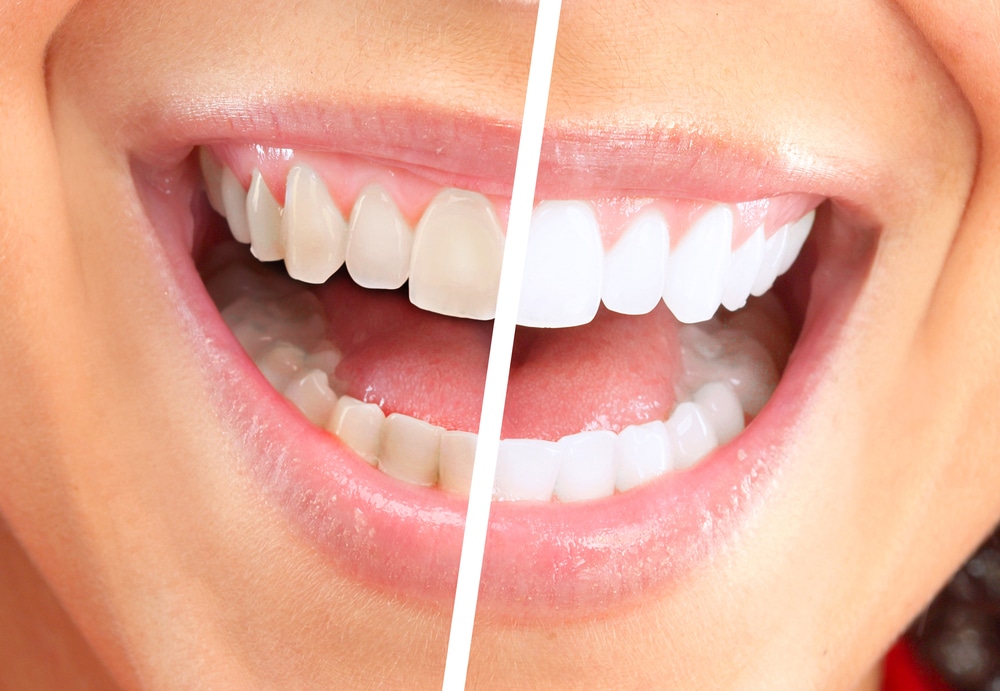 Happy,Smiling,Woman.,Dental,Health,Background. teeth whitening near me